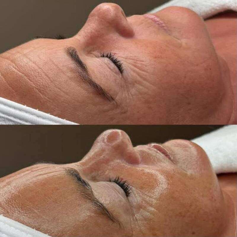 Hydro Facial 11 in 1