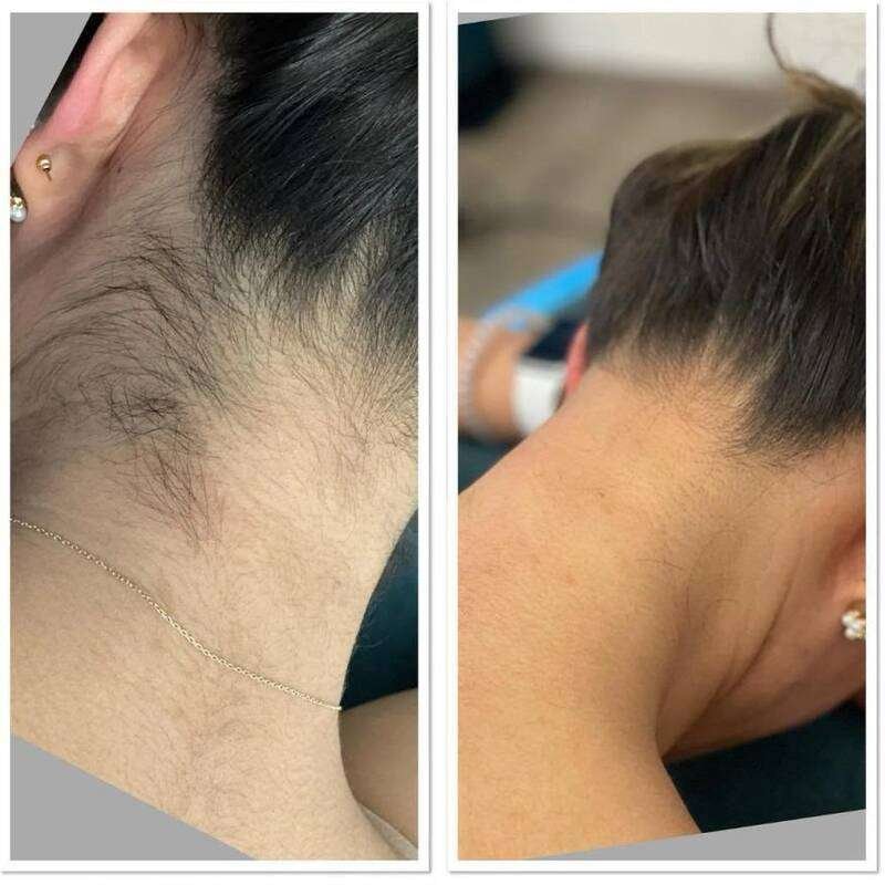 Laser hair removal