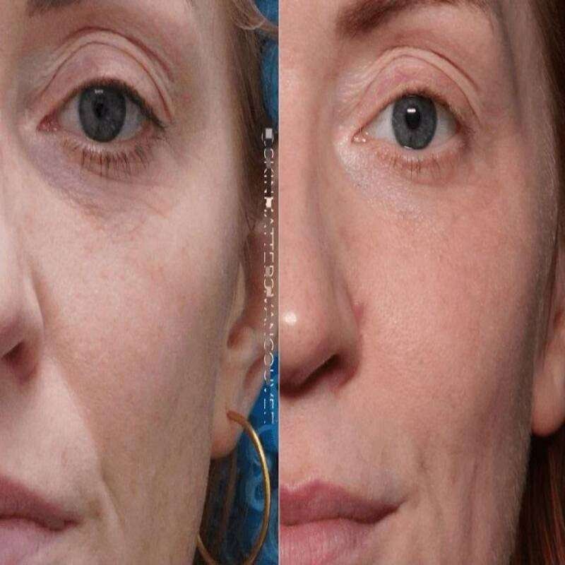 Microneedling