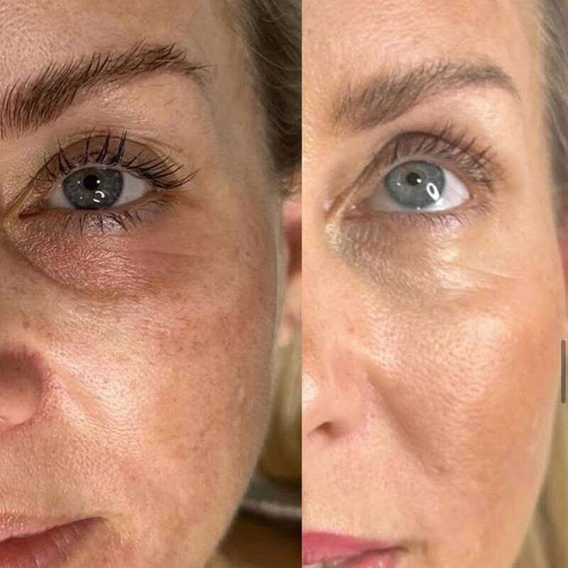 Skin boosters
