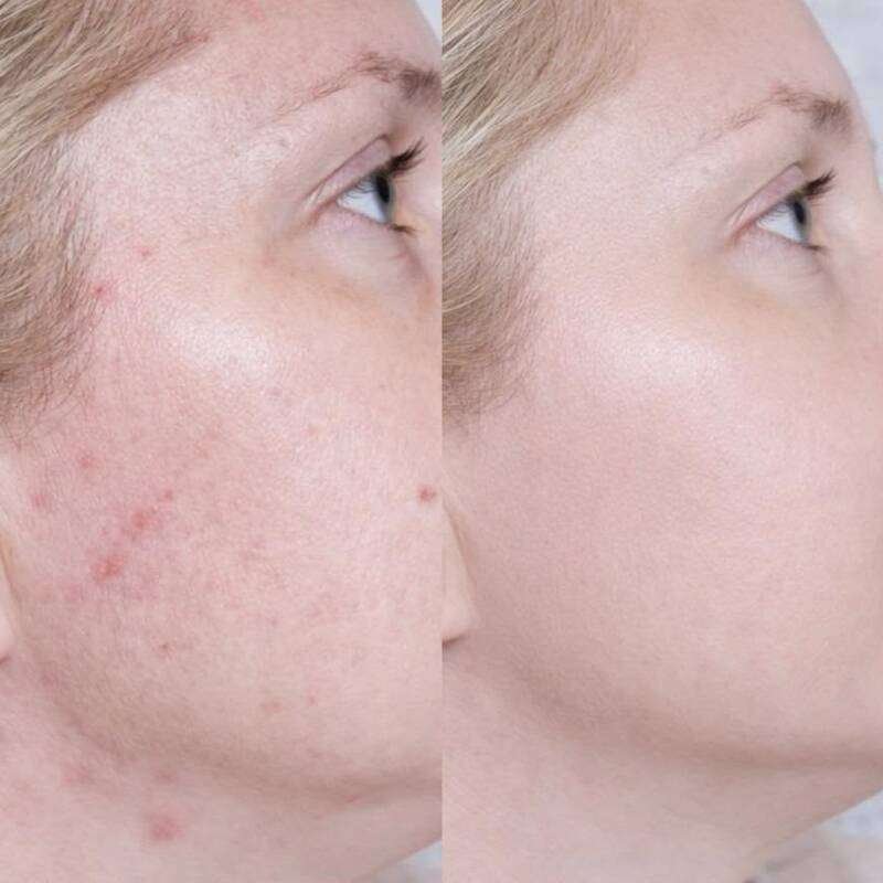 Cosmetic Grade Chemical Peels
