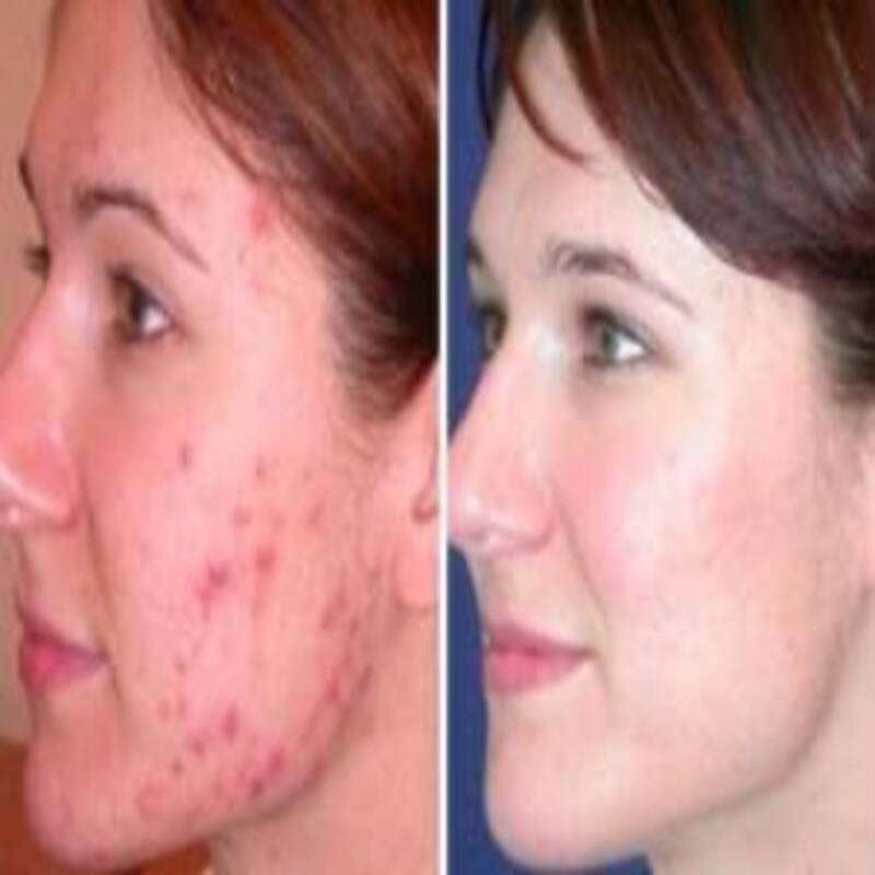 LED Light Therapy