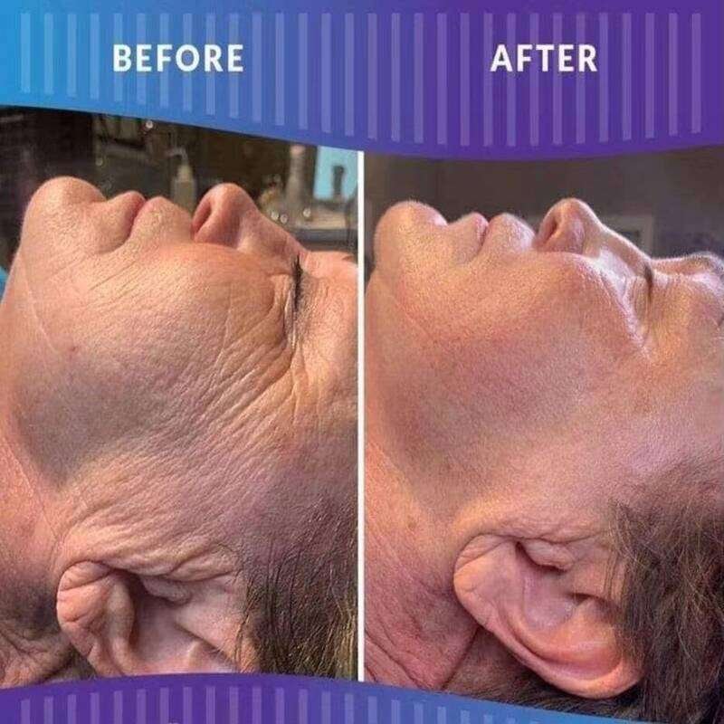 Fat Dissolving Injectables
