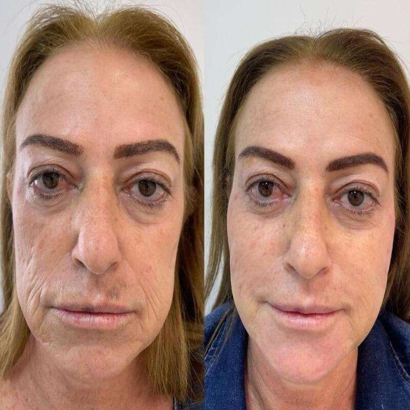 HIFU - High intensity focused ultrasound Non-surgical lift