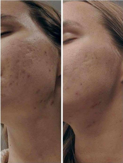 Fractional CO2 Laser Before and After