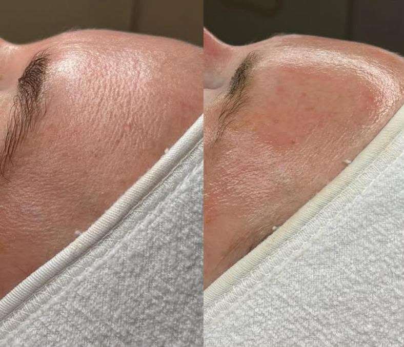 Mesotherapy