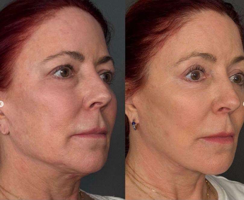 Skin Needling Before and After
